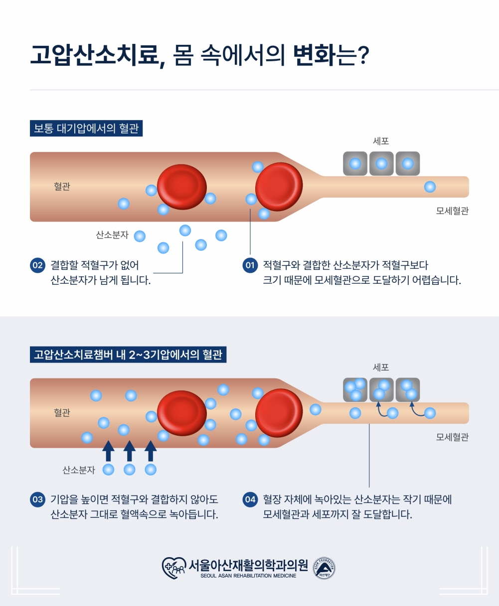 두통 mri, 고압산소치료(HBOT)